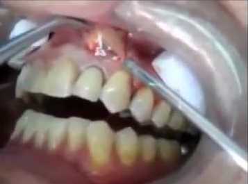 Un Posto Insolito Per Un Brufolo Il Dentrista Apre La Gengiva Del Paziente Ed Esplode Una Bomba Da Guinness Benessere