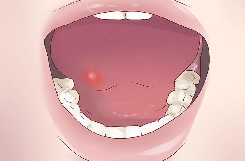Papilloma virus e tumore alla lingua